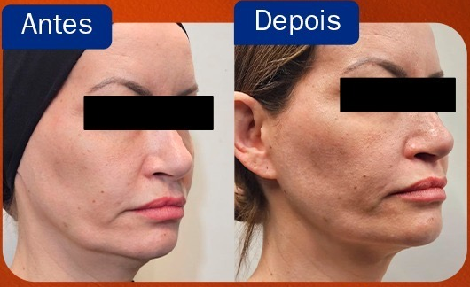 Comparação antes e depois de Linear Z em dois ângulos, com faixas pretas nos olhos preservadas do material original