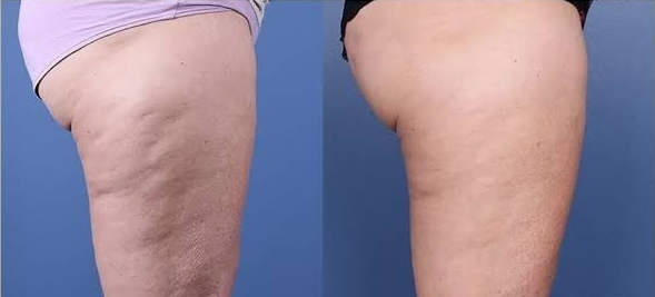 Antes e depois da lateral da coxa