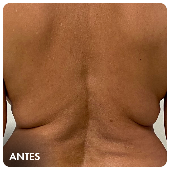 Antes: região das costas
