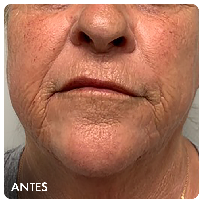 Antes: região perioral