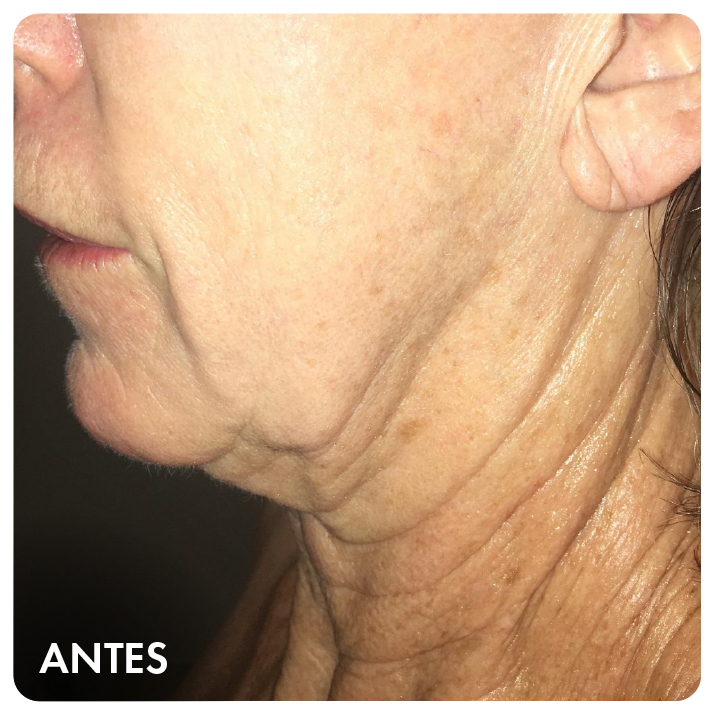 Antes: face e pescoço