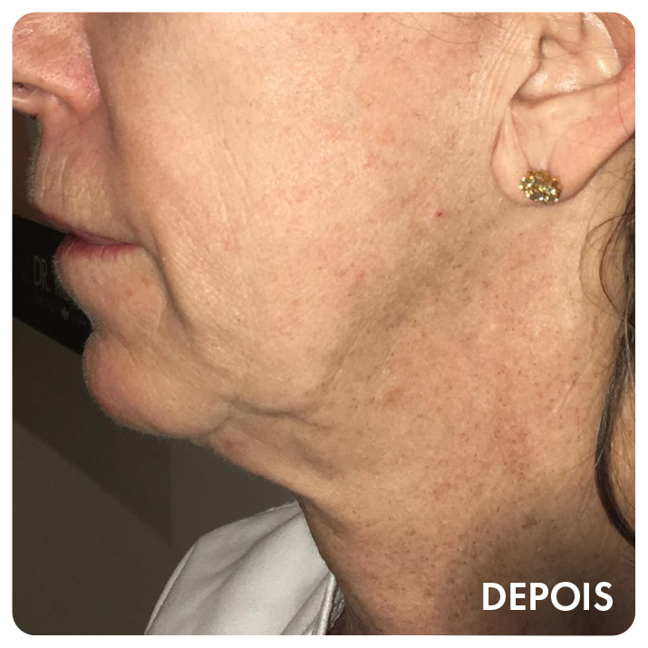 Depois: face e pescoço